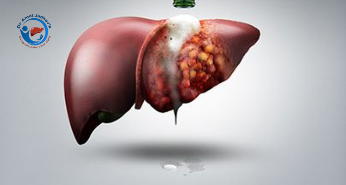Liver Cancer Treatment in Pune: Causes, Symptoms, Diagnosis and Treatment Options